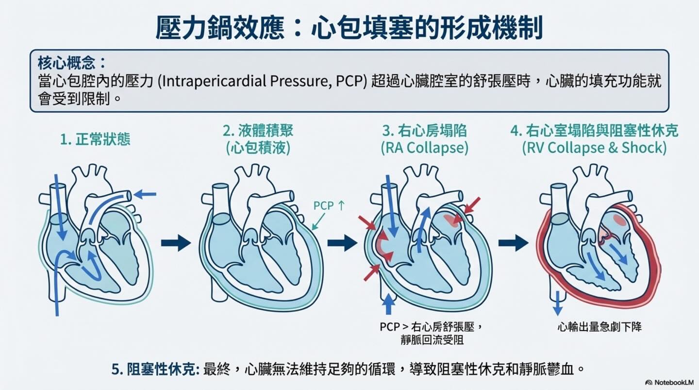 心包填塞：致命的壓力鍋圖卡 3