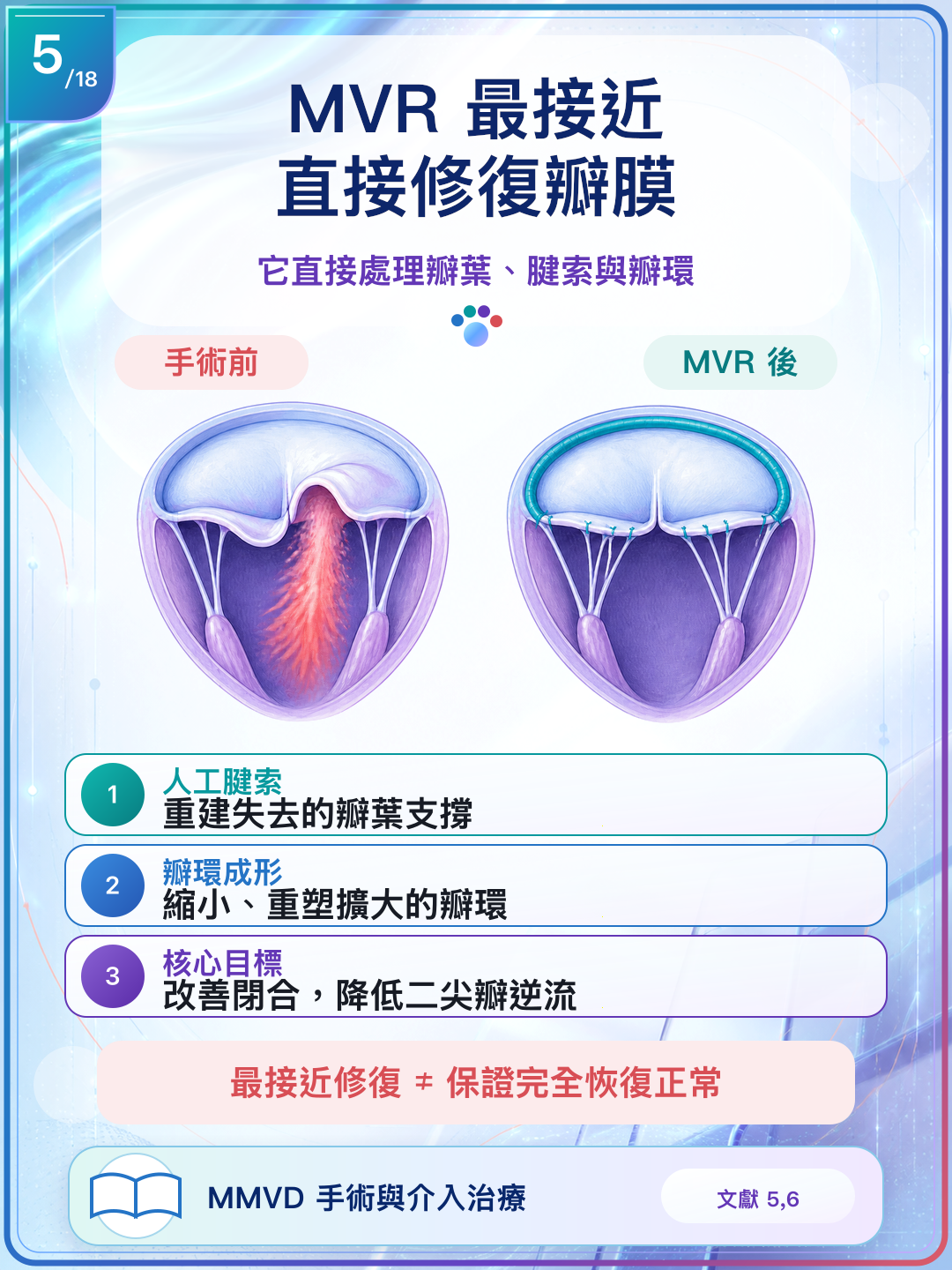 MVR 以人工腱索與瓣環成形直接處理瓣膜結構。