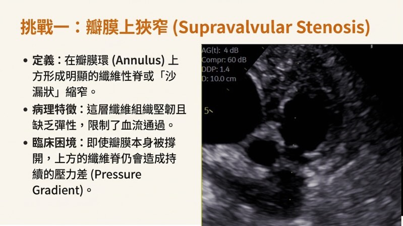 TPSA｜肺動脈瓣支架置放術圖卡 3：挑戰一：瓣膜上狹窄（Supravalvular Stenosis）