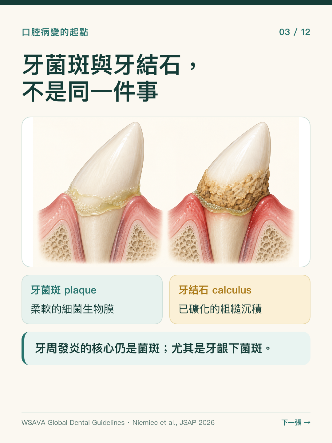 牙菌斑是柔軟的細菌生物膜，牙結石是礦化沉積；牙周發炎與菌斑相關。