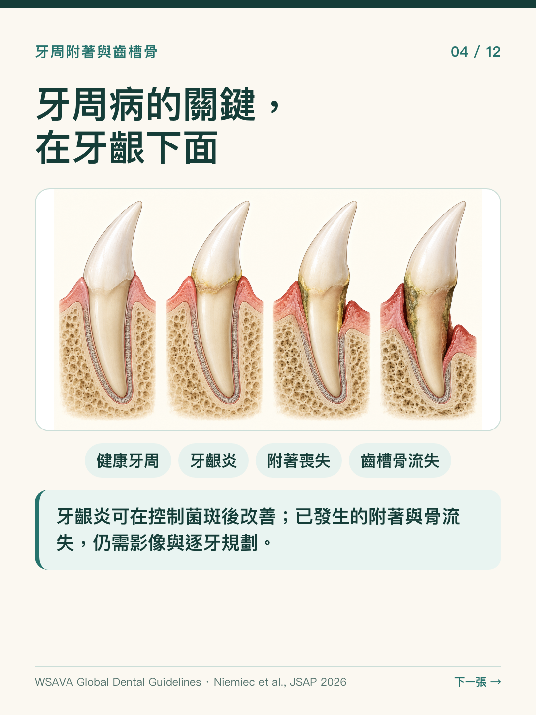 圖解健康牙周、牙齦炎、牙周附著喪失及齒槽骨流失，區分發炎與附著流失。