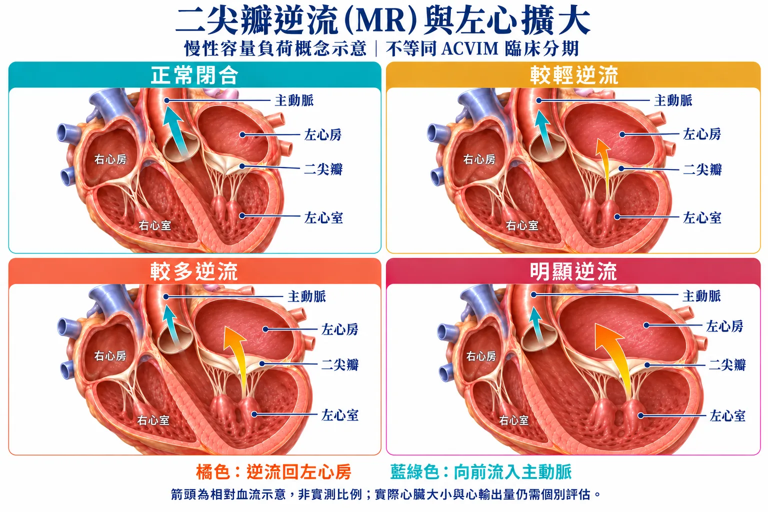 四格慢性容量負荷概念圖:左心房與左心室腔逐格擴大,中隔輪廓向畫面左側的右心偏移,右心相對占比縮小;主動脈位於二尖瓣的畫面左側。由左心室逆流回左心房的橘色箭頭逐格加粗,向前流入主動脈的藍綠色箭頭逐格變細。